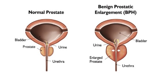 Normal Prostate vs Enlarged Prostate